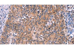 Immunohistochemistry of paraffin-embedded Human cervical cancer tissue using EDN1 Polyclonal Antibody at dilution 1:50 (Endothelin 1 anticorps)