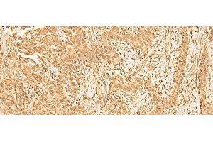 Immunohistochemistry of paraffin-embedded Human ovarian cancer tissue using ZNF471 Polyclonal Antibody at dilution of 1:50(x200) (ZNF471 anticorps)