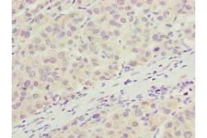 Immunohistochemistry of paraffin-embedded human liver cancer using ABIN7166405 at dilution of 1:100 (ARMT1 (AA 2-250) anticorps)