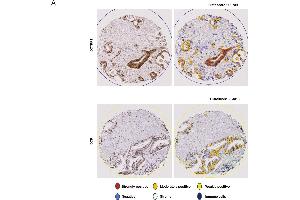 DCK expression is associated with outcome in gemcitabine-treated patients.