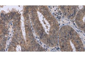 Immunohistochemistry of paraffin-embedded Human colon cancer using CDK5 Polyclonal Antibody at dilution of 1:30 (CDK5 anticorps)