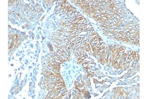 Formalin-fixed, paraffin-embedded human Esophageal carcinoma stained with TRIM29 Mouse Monoclonal Antibody (TRIM29/1041). (TRIM29 anticorps  (AA 1-200))