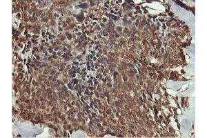 Immunohistochemical staining of paraffin-embedded Adenocarcinoma of Human breast tissue using anti-AKT1 mouse monoclonal antibody. (AKT1 anticorps)