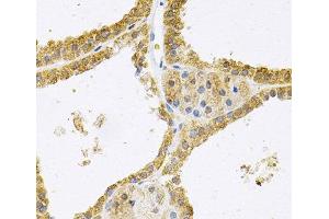 Immunohistochemistry of paraffin-embedded Human thyroid cancer using FHL1 Polyclonal Antibody at dilution of 1:100 (40x lens). (FHL1 anticorps)