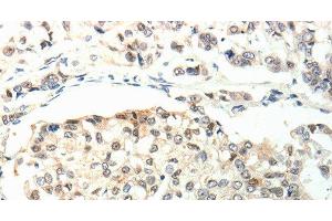 Immunohistochemistry of paraffin-embedded Human breast cancer using TPM2 Polyclonal Antibody at dilution of 1:60 (TPM2 anticorps)