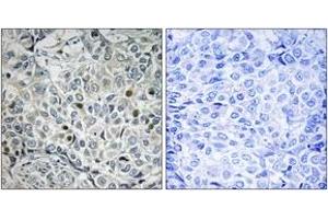 Immunohistochemistry analysis of paraffin-embedded human breast carcinoma, using USP53 Antibody. (USP53 anticorps  (AA 951-1000))