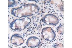 IHC-P analysis of Human Stomach Cancer Tissue, with DAB staining. (ATP6AP2 anticorps  (AA 17-302))