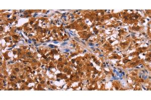 Immunohistochemistry of paraffin-embedded Human thyroid cancer tissue using USP2 Polyclonal Antibody at dilution 1:40