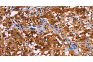 Immunohistochemistry of paraffin-embedded Human thyroid cancer tissue using USP2 Polyclonal Antibody at dilution 1:40 (USP2 anticorps)