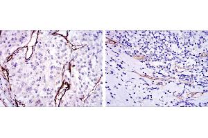 Immunohistochemical analysis of paraffin-embedded kidney cancer tissues (left) and stomach cancer tissues (right) using CD105 mouse mAb with DAB staining.