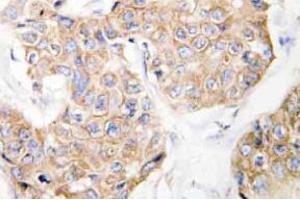 Immunohistochemistry analysis of CD213a1 / IL13RA1 Antibody in paraffin-embedded human breast carcinoma tissue. (IL13 Receptor alpha 1 anticorps)