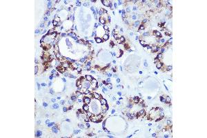 Immunohistochemistry of paraffin-embedded human thyroid cancer using HK1 Rabbit mAb (ABIN7267638) at dilution of 1:100 (40x lens).
