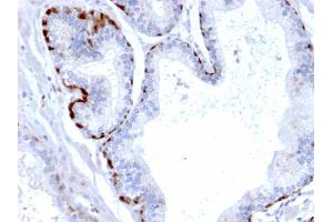 Formalin-fixed, paraffin-embedded human Prostate Carcinoma stained with Cystatin A Mouse Monoclonal Antibody (CPTC-CSTA-1).