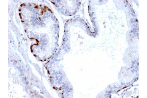 Formalin-fixed, paraffin-embedded human Prostate Carcinoma stained with Cystatin A Mouse Monoclonal Antibody (CPTC-CSTA-1). (CSTA anticorps)