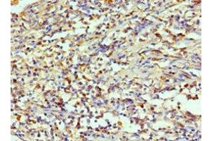 Immunohistochemistry of paraffin-embedded human cervical cancer using ABIN7143994 at dilution of 1:100