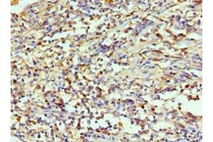 Immunohistochemistry of paraffin-embedded human cervical cancer using ABIN7143994 at dilution of 1:100 (AIMP1 anticorps  (AA 25-180))