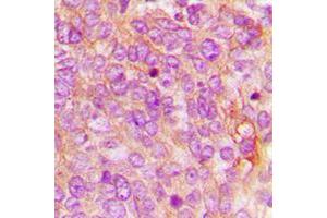 Immunohistochemical analysis of MDA5 staining in human breast cancer formalin fixed paraffin embedded tissue section.
