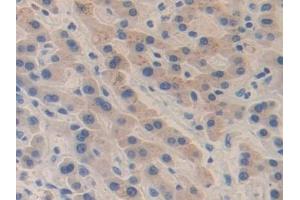 Detection of F5 in Human Liver cancer Tissue using Polyclonal Antibody to Coagulation Factor V (F5)
