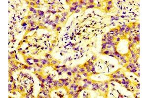 IHC image of ABIN7150786 diluted at 1:600 and staining in paraffin-embedded human bladder cancer performed on a Leica BondTM system.