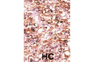 Formalin-fixed and paraffin-embedded human hepatocellular carcinoma tissue reacted with ACVR2B polyclonal antibody  , which was peroxidase-conjugated to the secondary antibody, followed by AEC staining. (ACVR2B anticorps  (N-Term))