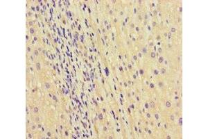 Immunohistochemistry of paraffin-embedded human liver cancer using ABIN7168865 at dilution of 1:100