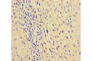 Immunohistochemistry of paraffin-embedded human liver cancer using ABIN7168865 at dilution of 1:100 (Septin 2 anticorps  (AA 1-361))