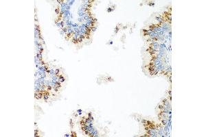 Immunohistochemistry of paraffin-embedded human prostate using UBIAD1 antibody at dilution of 1:100 (40x lens). (UBIAD1 anticorps)