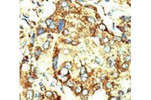 IHC analysis of FFPE human hepatocarcinoma stained with the Dnmt2 antibody