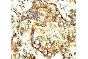 IHC analysis of FFPE human hepatocarcinoma stained with the Dnmt2 antibody (Dnmt2 anticorps  (AA 346-375))
