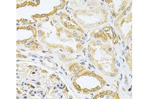 Immunohistochemistry of paraffin-embedded Human kidney cancer using VAPB Polyclonal Antibody at dilution of 1:200 (40x lens). (VAPB anticorps)