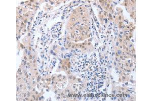 Immunohistochemistry of Human lung cancer using APEX1 Polyclonal Antibody at dilution of 1:20 (APEX1 anticorps)