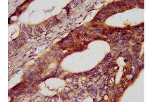 IHC image of ABIN7146237 diluted at 1:400 and staining in paraffin-embedded human colon cancer performed on a Leica BondTM system.