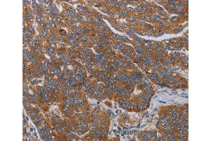 Immunohistochemistry of Human cervical cancer using PARP10 Polyclonal Antibody at dilution of 1:30 (PARP10 anticorps)