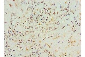 Immunohistochemistry of paraffin-embedded human breast cancer using ABIN7144316 at dilution of 1:100 (AGR2 anticorps  (AA 21-175))