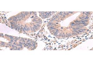 Immunohistochemistry of paraffin-embedded Human colorectal cancer tissue using GKAP1 Polyclonal Antibody at dilution of 1:95(x200) (GKAP1 anticorps)