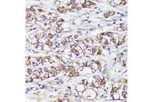 Immunohistochemistry of paraffin-embedded human liver cancer using MTHFD2 antibody (ABIN6132367, ABIN6144144, ABIN6144145 and ABIN6214625) at dilution of 1:100 (40x lens). (MTHFD2 anticorps  (AA 40-250))