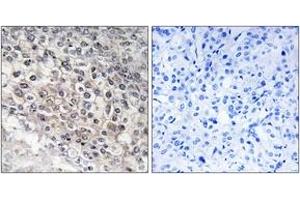 Immunohistochemistry analysis of paraffin-embedded human liver carcinoma tissue, using Cytochrome P450 2W1 Antibody. (CYP2W1 anticorps  (AA 311-360))