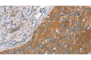Immunohistochemistry of paraffin-embedded Human cervical cancer tissue using Crystallin-alpha C Polyclonal Antibody at dilution 1:45