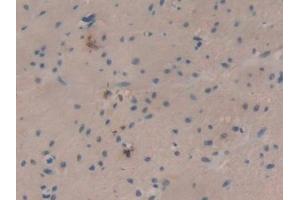 DAB staining on IHC-P; Samples: Human Colorectal cancer Tissue