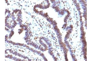 Formalin-fixed, paraffin-embedded human Ovarian Carcinoma stained with EMI1 Mouse Monoclonal Antibody (EMI1/1176). (FBXO5 anticorps  (AA 1-250))