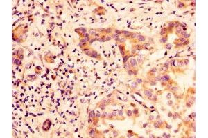 IHC image of ABIN7153857 diluted at 1:100 and staining in paraffin-embedded human liver cancer performed on a Leica BondTM system. (GLIPR1 anticorps  (AA 22-232))