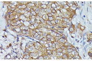 Immunohistochemistry of paraffin-embedded Human mammary cancer using CTTN Polyclonal Antibody at dilution of 1:100 (40x lens). (Cortactin anticorps)