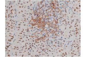 ABIN6267411 at 1/200 staining Human lung cancer tissue sections by IHC-P.