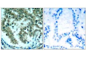 Immunohistochemical analysis of paraffin-embedded human lung carcinoma tissue, using PKCθ (Ab-676) antibody (E021289). (PKC theta anticorps)