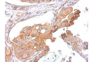 IHC-P Image CCR8 antibody detects CCR8 protein at membrane on human gastric cancer by immunohistochemical analysis. (CCR8 anticorps  (C-Term))
