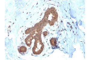 Formalin-fixed, paraffin-embedded human Breast Carcinoma stained with GSTMu2 Mouse Monoclonal Antibody (CPTC-GSTMu2-2). (GSTM4 anticorps)