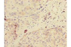 Immunohistochemistry of paraffin-embedded human liver cancer using ABIN7154172 at dilution of 1:100