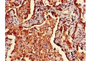 Immunohistochemistry of paraffin-embedded human lung cancer using ABIN7155618 at dilution of 1:100 (HLA-DRB1 anticorps  (AA 31-266) (Biotin))