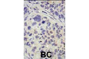 Formalin-fixed and paraffin-embedded human cancer tissue reacted with USP8 polyclonal antibody  , which was peroxidase-conjugated to the secondary antibody, followed by AEC staining . (USP8 anticorps  (C-Term))