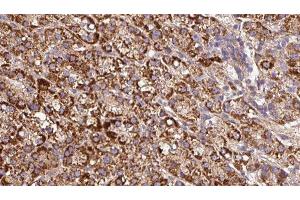 ABIN6279676 at 1/100 staining Human liver cancer tissue by IHC-P. (Kcne3 anticorps  (Internal Region))